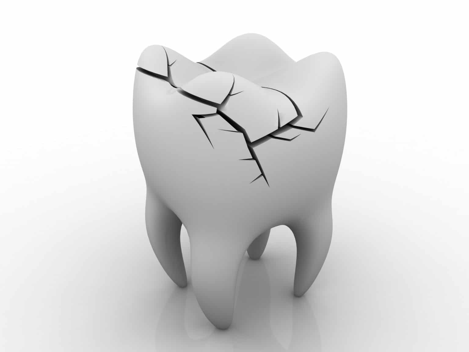 how-does-a-tooth-infection-occur-brunel-dental-practice